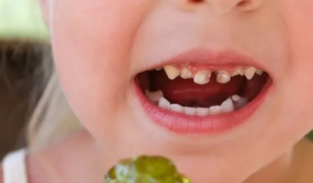 Okul çağındaki çocuklarda çürük riskine dikkat! Paketli gıdalar çocuk dişlerini vuruyor!