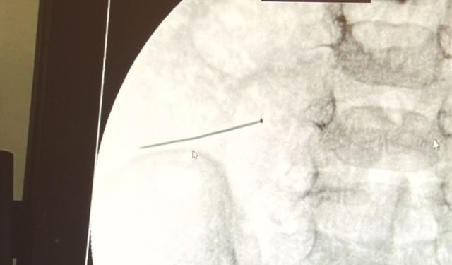 Ağrıyla kıvranan 2 yaşındaki çocuğun bağırsağından 3 santimlik iğne çıktı